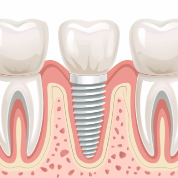 Implantología dental Sevilla