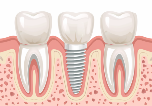 Implantología dental Sevilla
