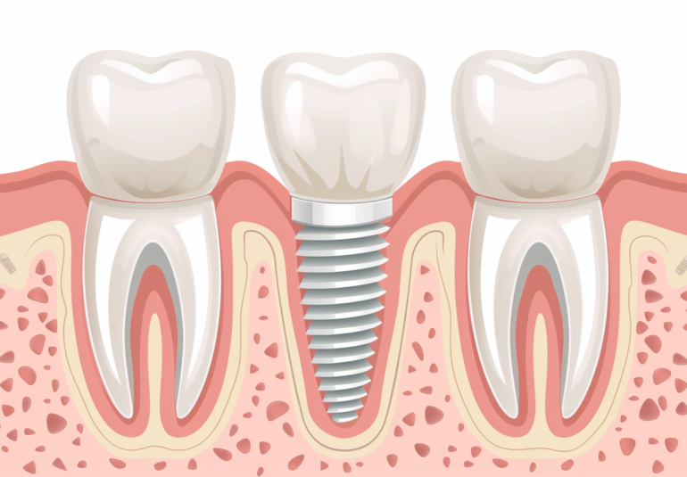 Implantología dental Sevilla